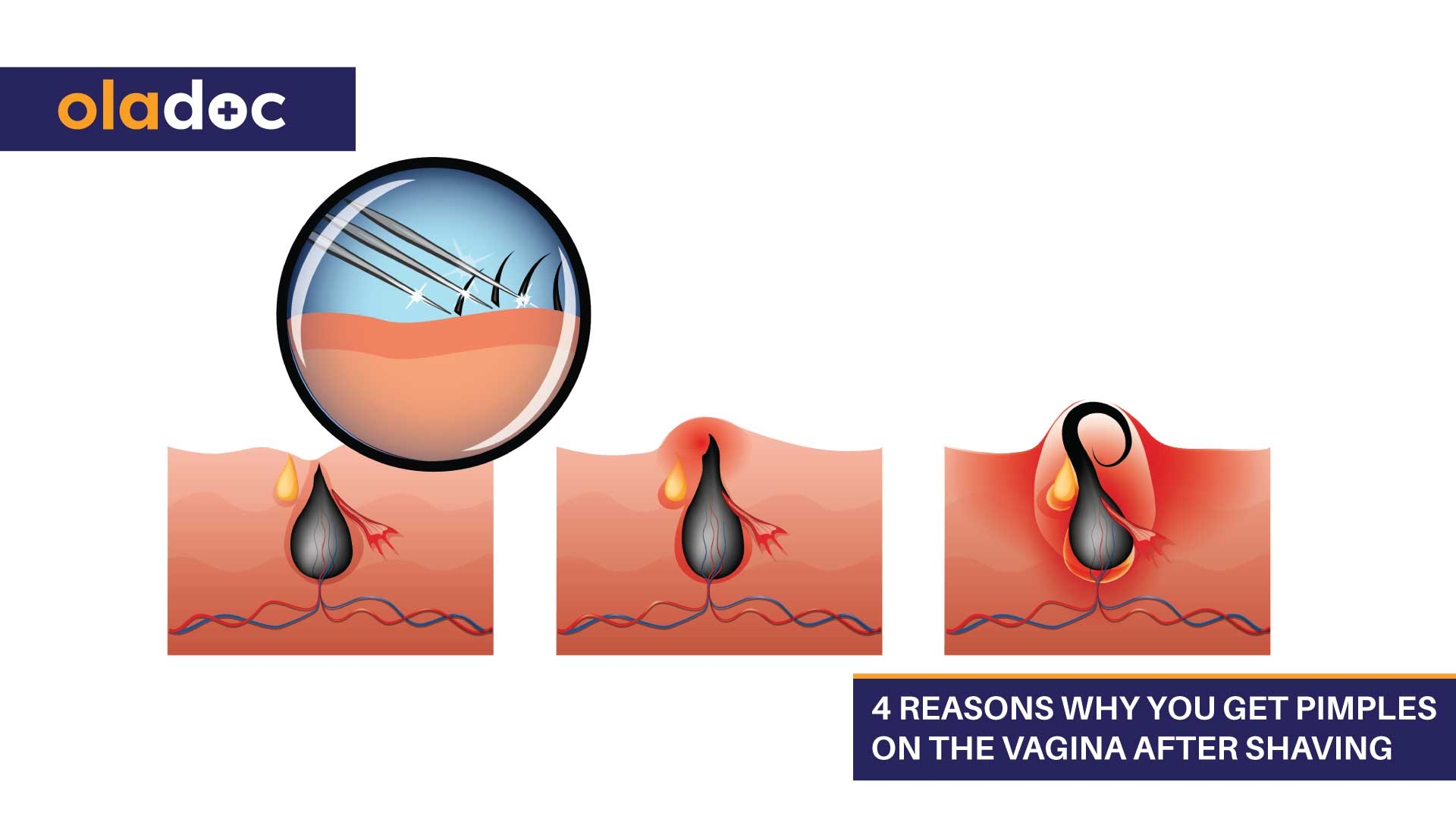 how to get rid of red dots after shaving