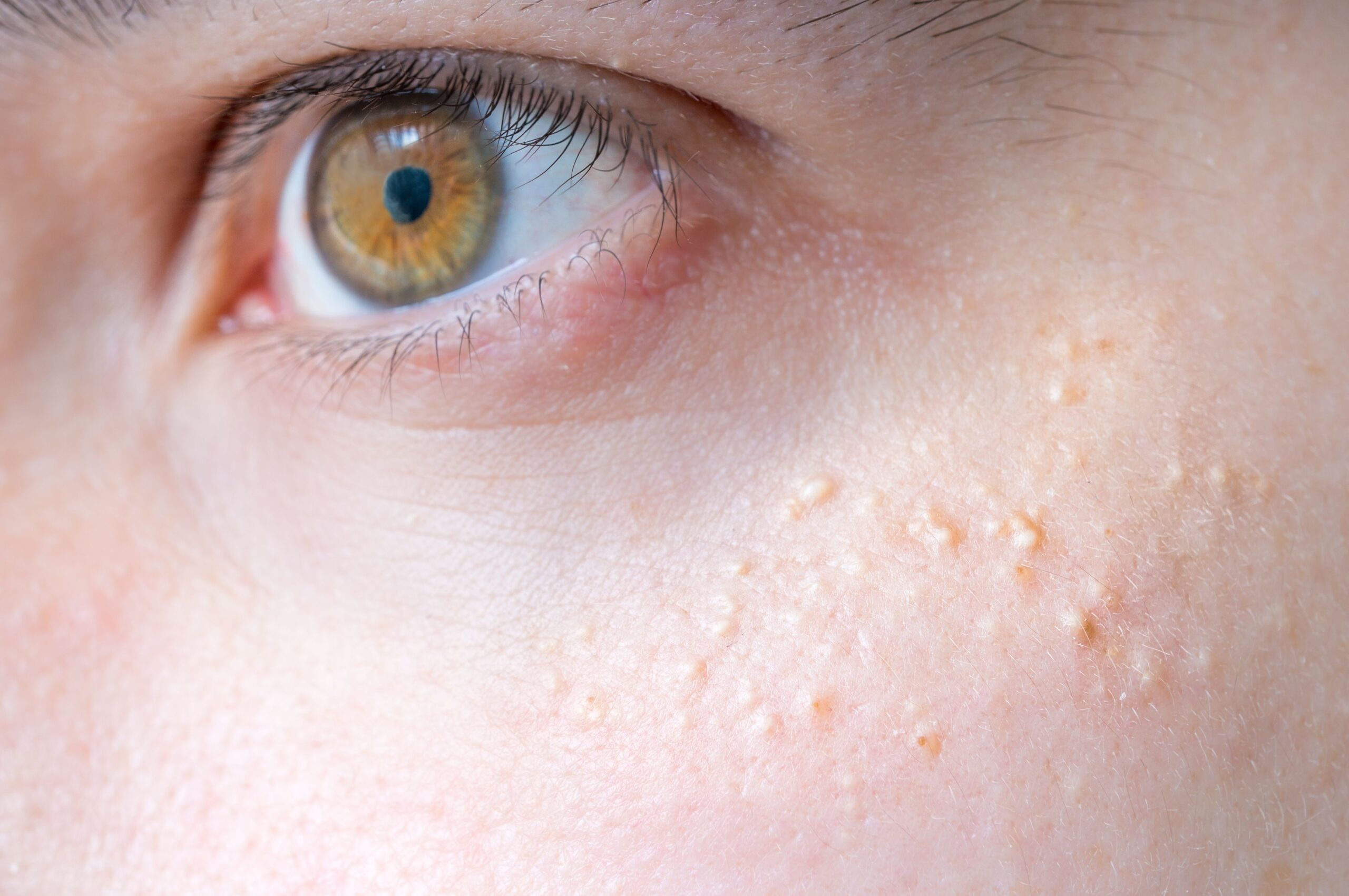 how to get rid of white dots on skin