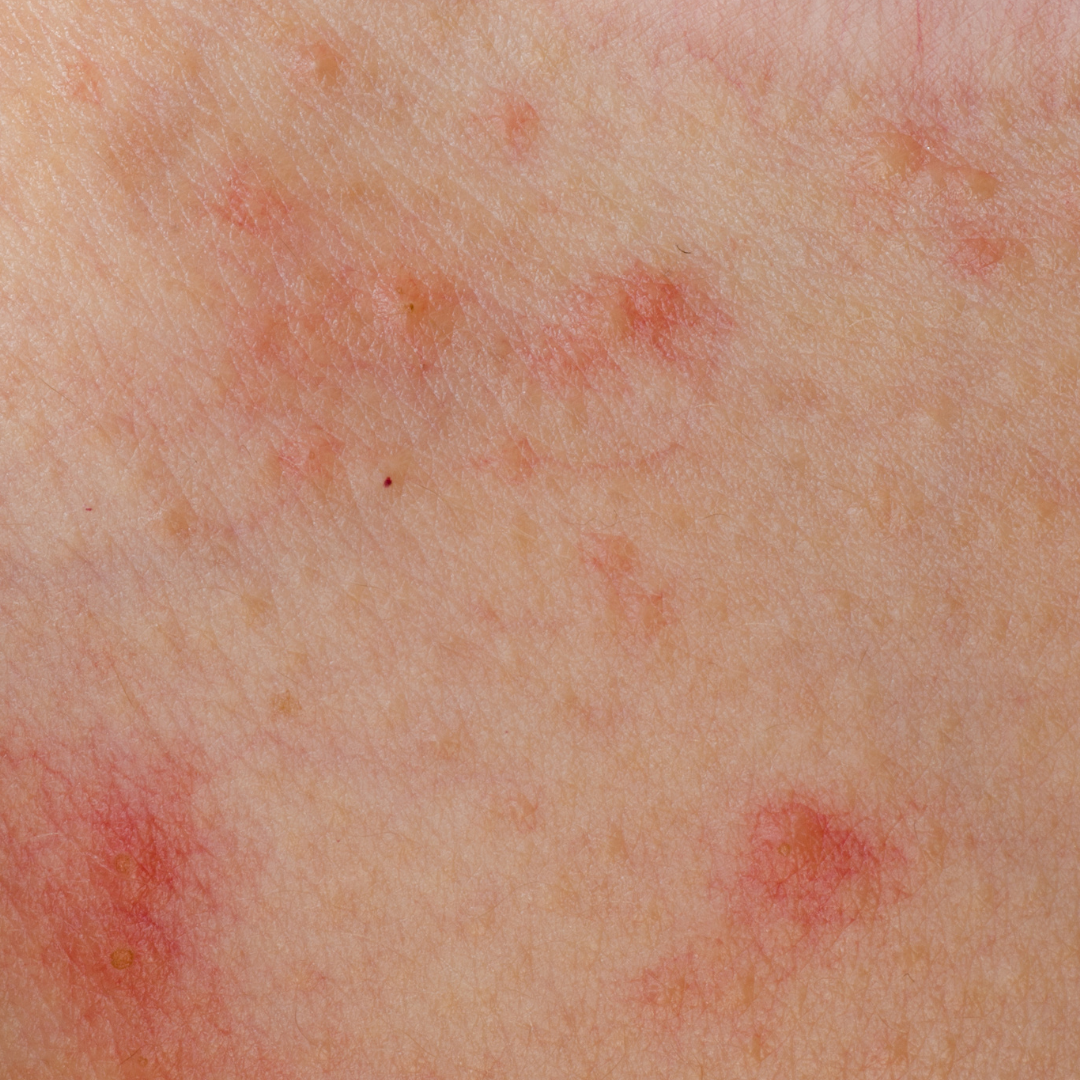 Beat The Burn 10 Top Tips To Get Rid Of Shaving Rash ProSkin Clinic U0026 Health UK