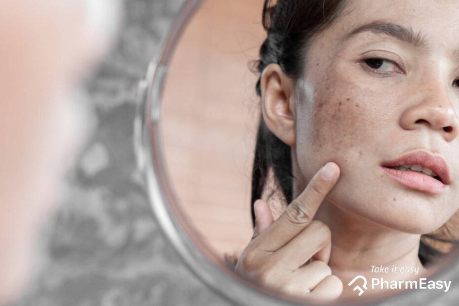 Here s How To Remove Dark Spots On Face Naturally PharmEasy