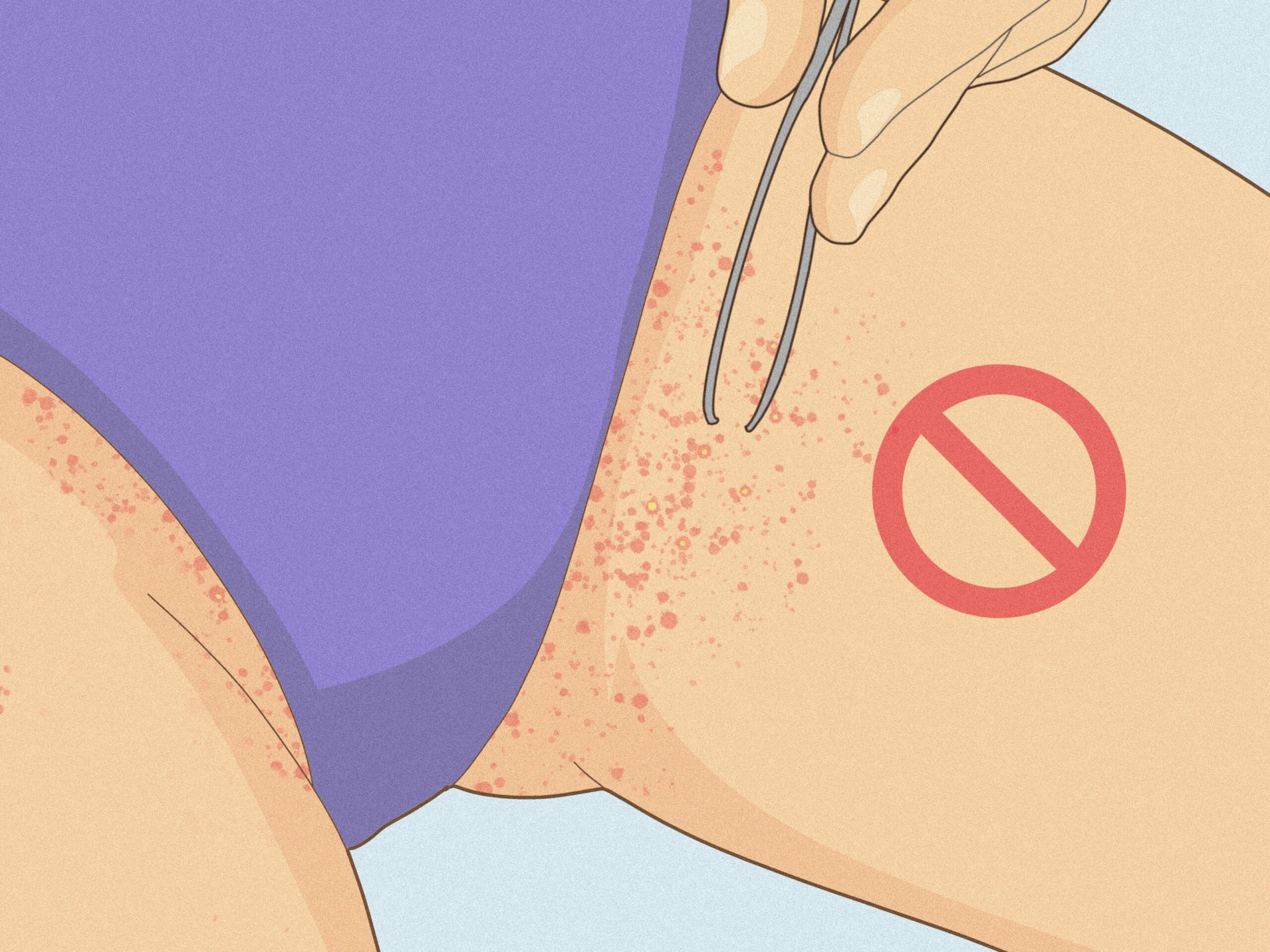 How To Get Rid Of Razor Bumps In The Bikini Area Easy Tips