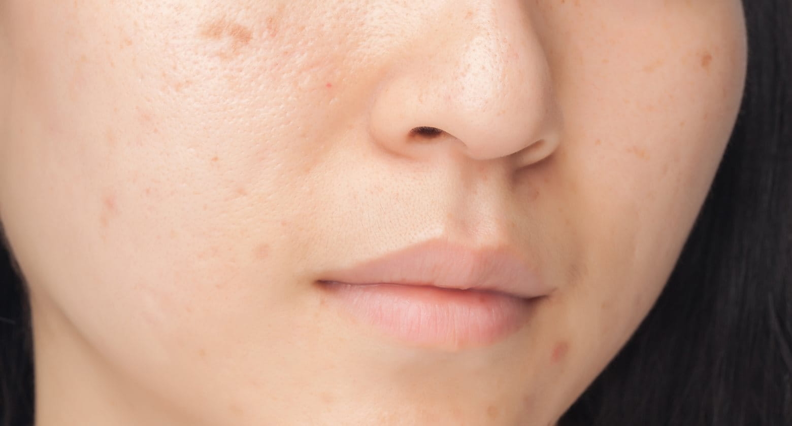 How To Get Rid Of Red Marks Left By Spots Eucerin UK