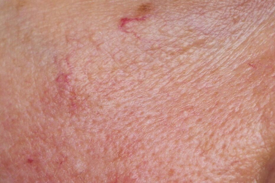 How To Get Rid Of Redness On Your Face According To Dermatologists SELF