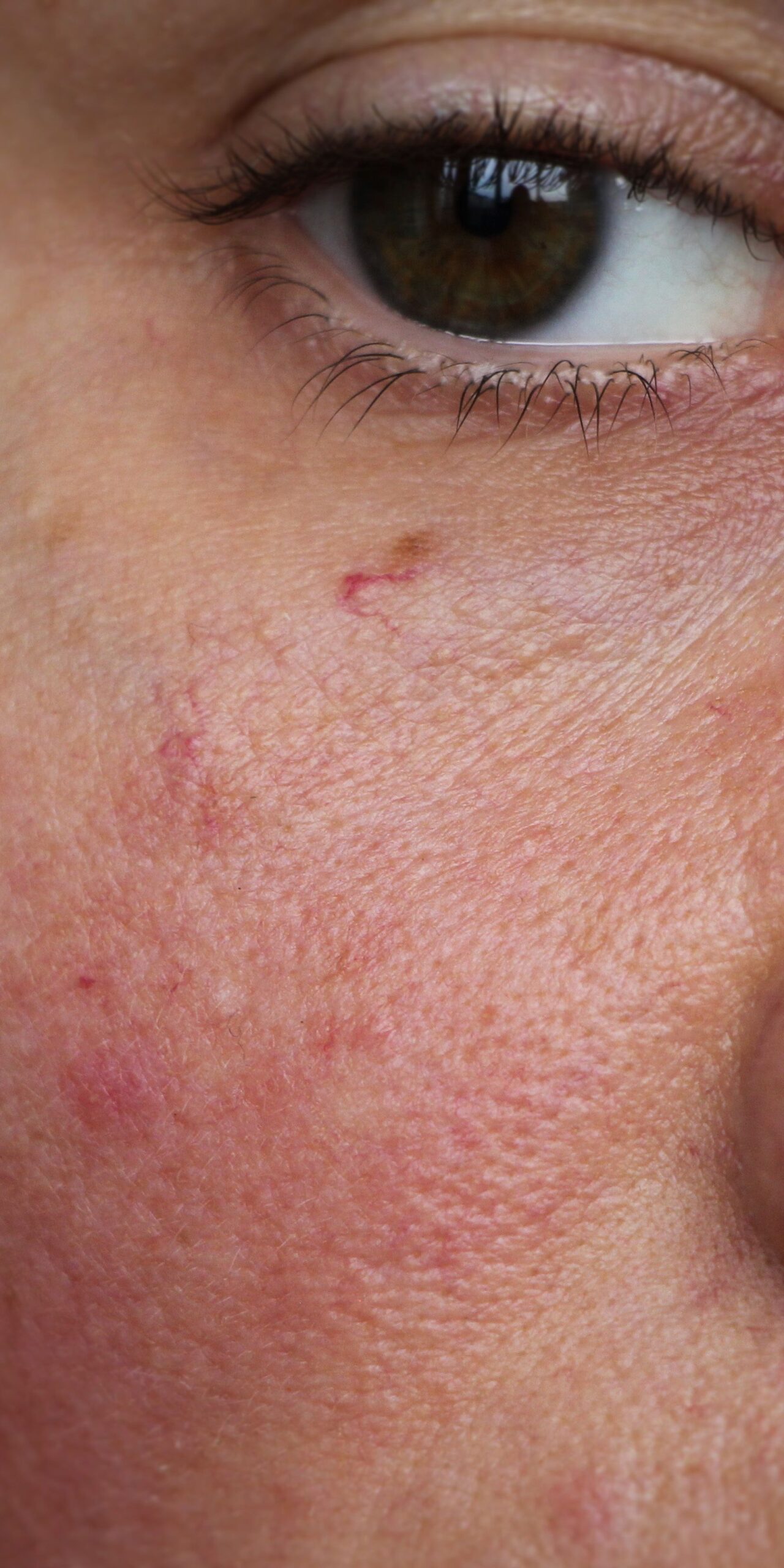 How To Get Rid Of Redness On Your Face According To Dermatologists SELF