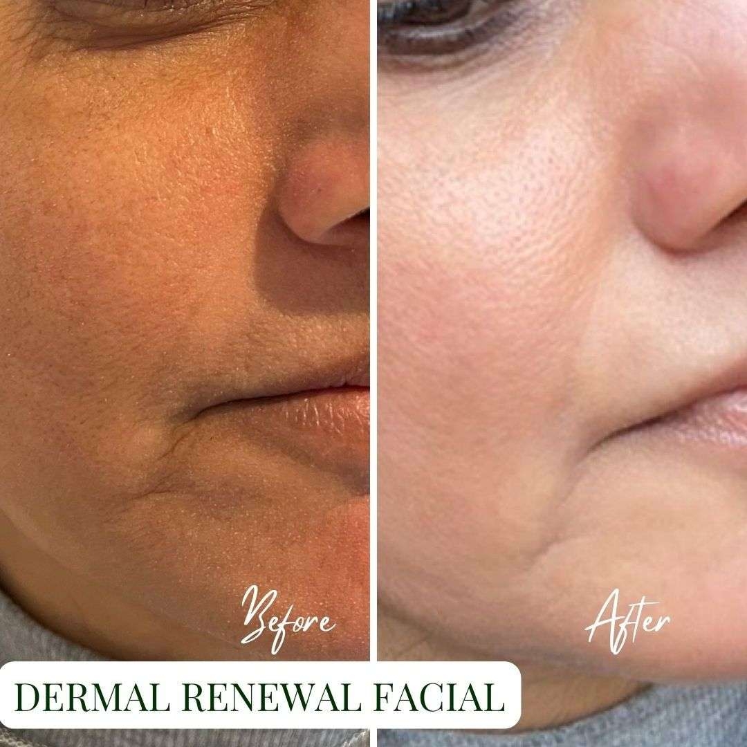 How To Remove Dark Spots On Face Organic Apoteke