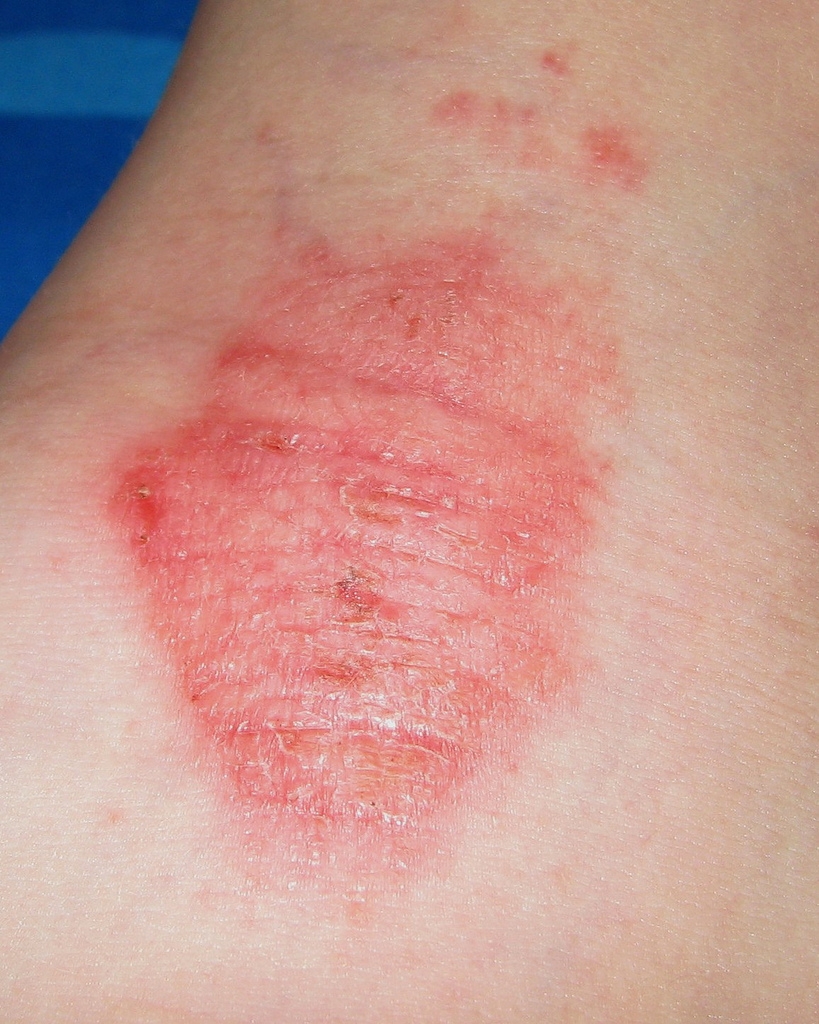 red dots on arm that appear due to sun