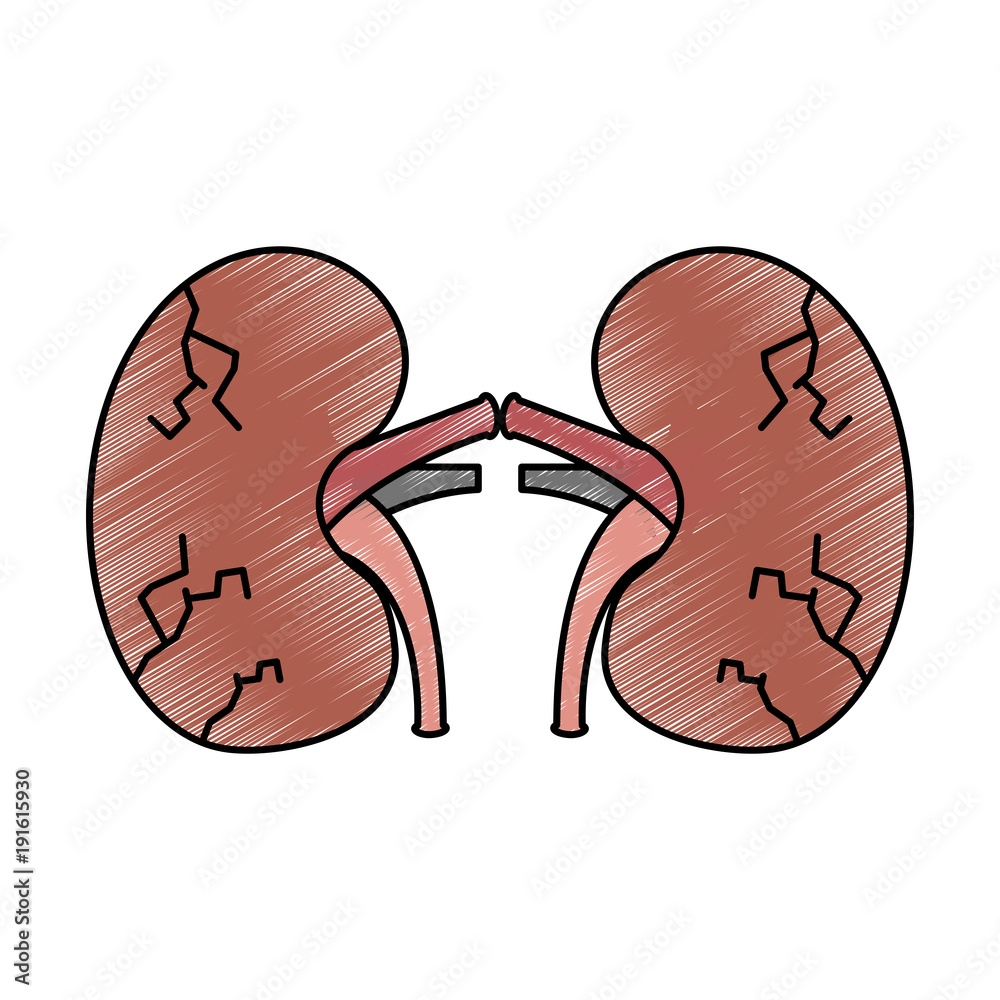 Kidneys Human Unhealthy Disease Medical Anatomic Damaged Vector Illustration Drawing Design Stock Vector Adobe Stock