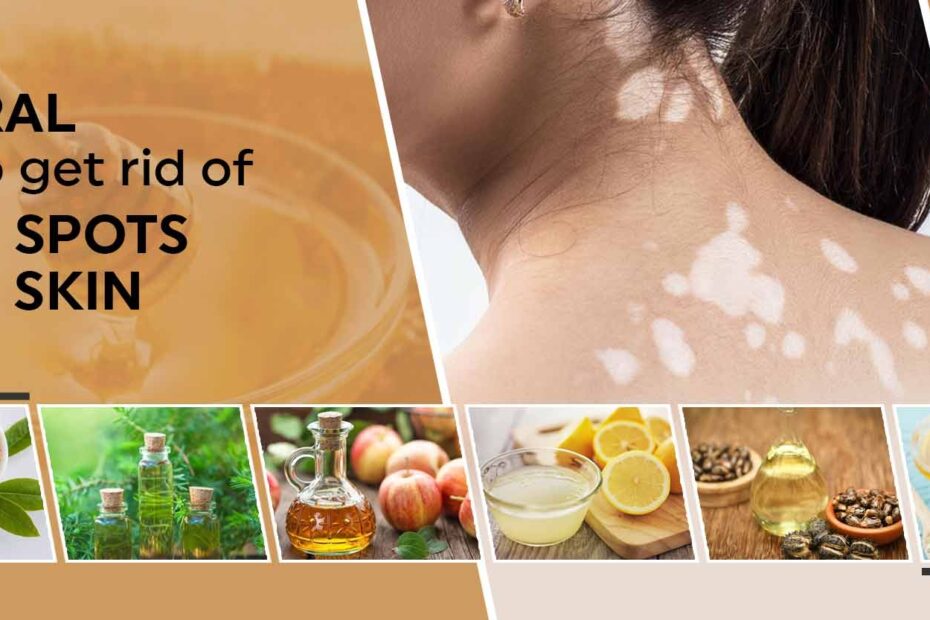 Natural Ways To Get Rid Of White Spots On Skin