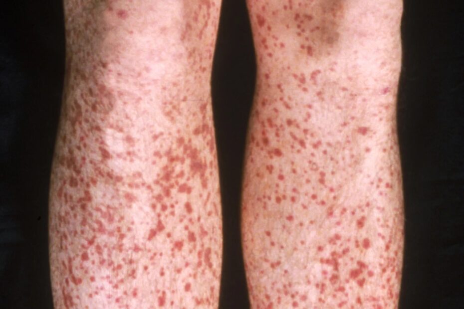 Petechiae Causes Symptoms Diagnosis U0026 Treatment