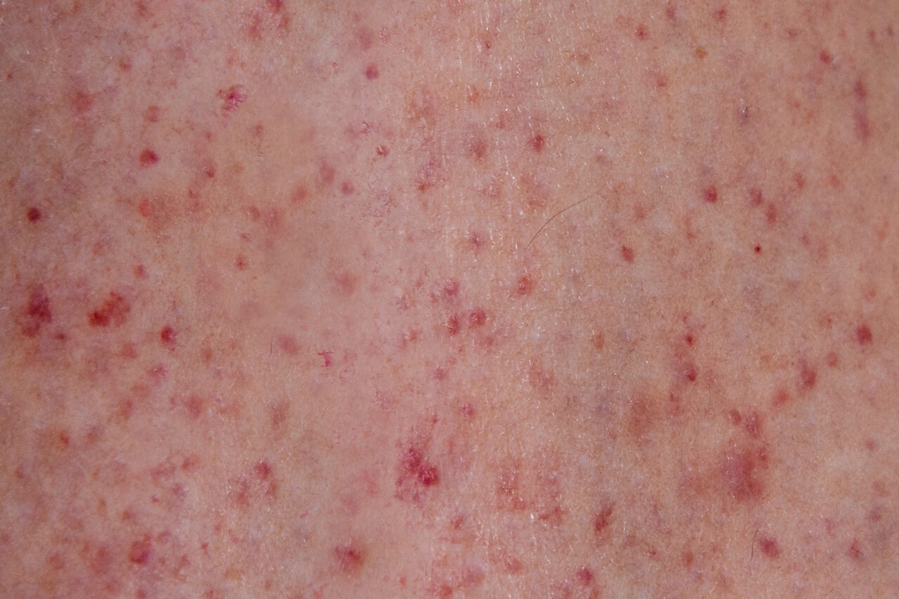 Red Dots On Skin The Link Between Leukemia And Petechiae