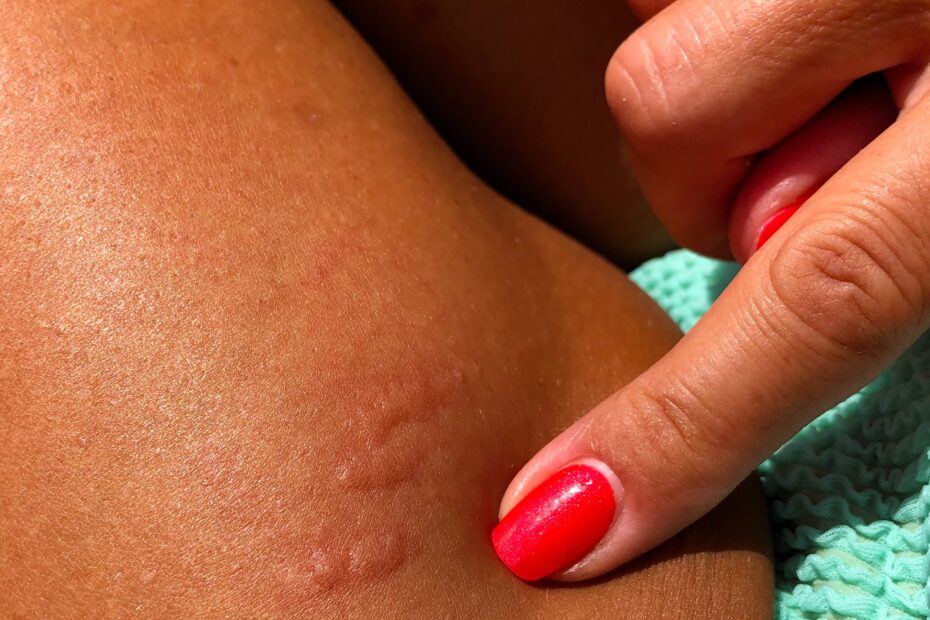 What Is Phytophotodermatitis PS Beauty
