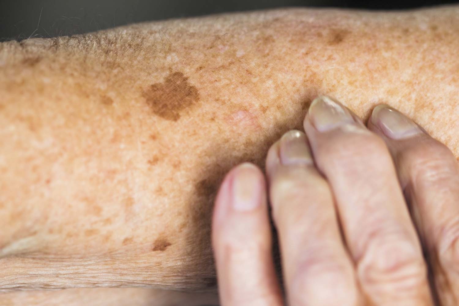 What s The Difference Between Age Spots And Sun Spots Harvard Health