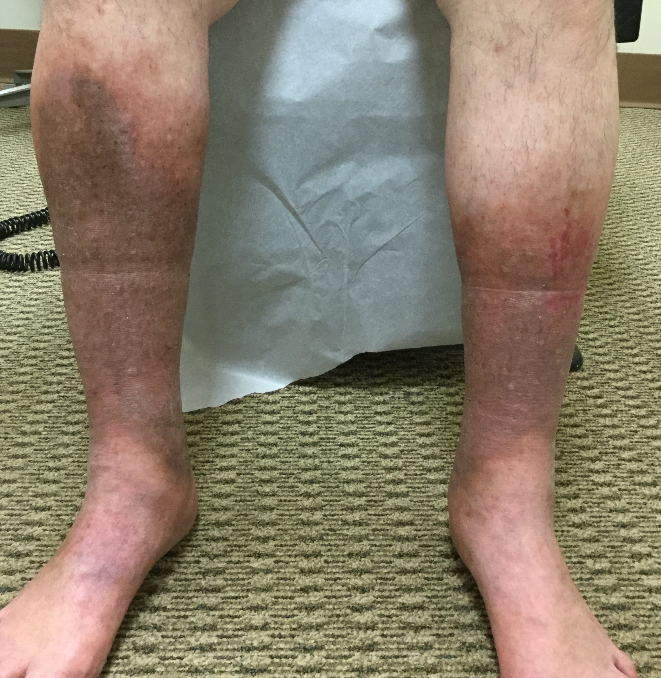 how to make bleeding dots on lower leg go away